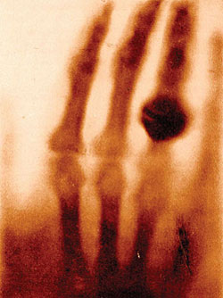 Exhibit 1. Röntgen's  First X-Ray Image