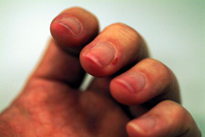Photo of red/sore fingernails