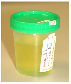 Image of urine sample
