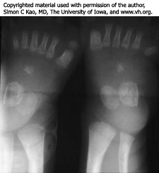 X-ray showing polydactyly