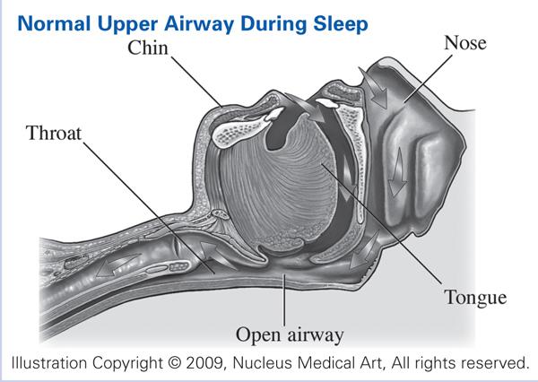 Normal Upper Airway During Sleep