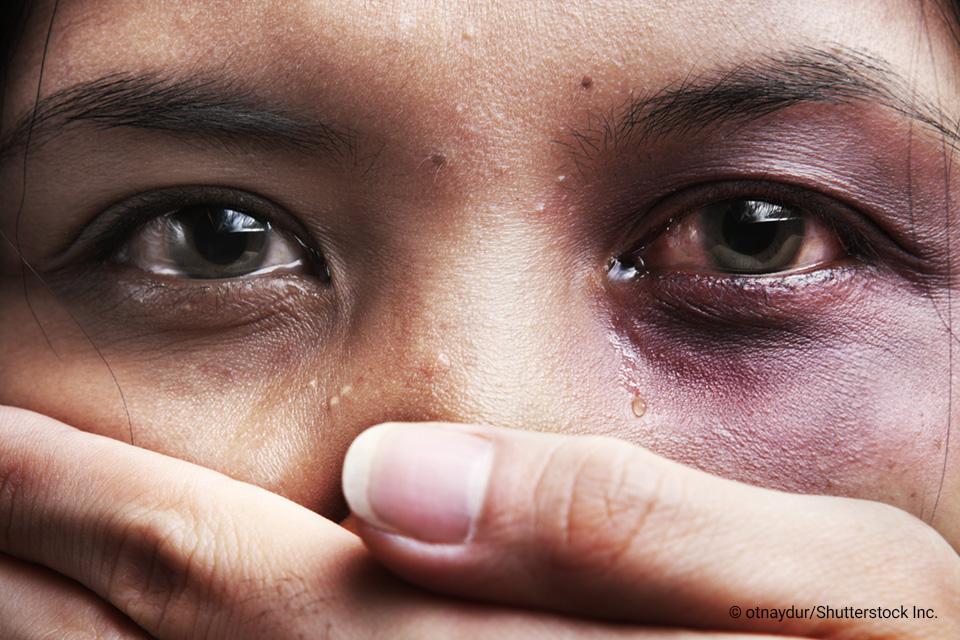 Woman with bruised eye with a hand covering her mouth