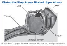 Obstructive Sleep Apnea: Blocked Airway
