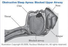 Obstructive Sleep Apnea: Blocked Airway Obstructive Sleep Apnea: Blocked Airway
