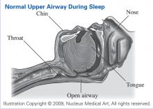 Normal Upper Airway During Sleep